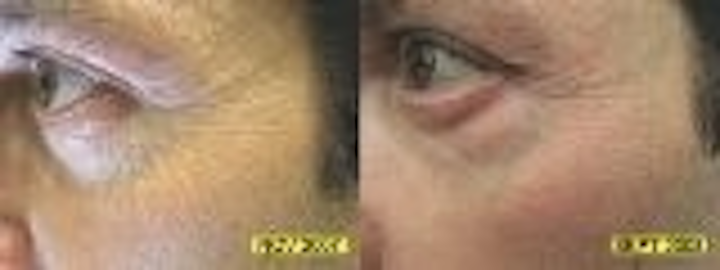 Content Dam Leds En Articles 2008 11 Led Light Shown To Reduce Face Wrinkles Leftcolumn Article Thumbnailimage File
